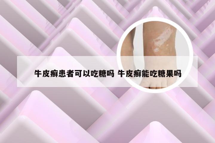 牛皮癣患者可以吃糖吗 牛皮癣能吃糖果吗