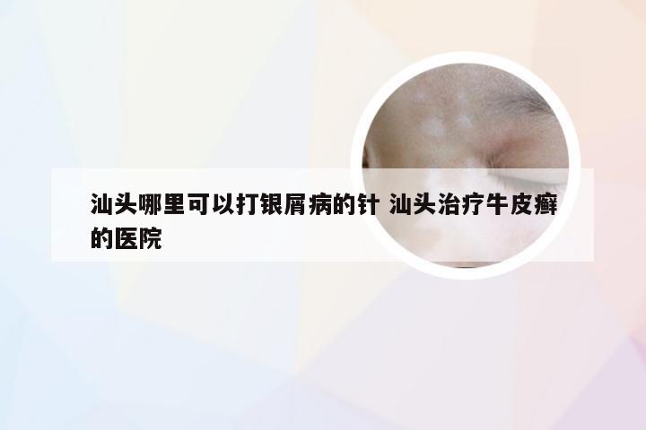 汕头哪里可以打银屑病的针 汕头治疗牛皮癣的医院
