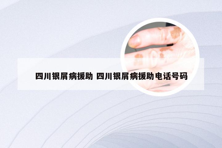 四川银屑病援助 四川银屑病援助电话号码