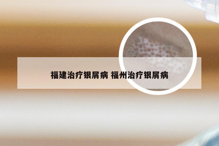 福建治疗银屑病 福州治疗银屑病