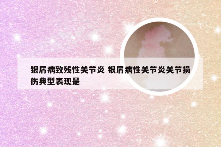 银屑病致残性关节炎 银屑病性关节炎关节损伤典型表现是
