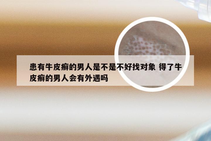 患有牛皮癣的男人是不是不好找对象 得了牛皮癣的男人会有外遇吗
