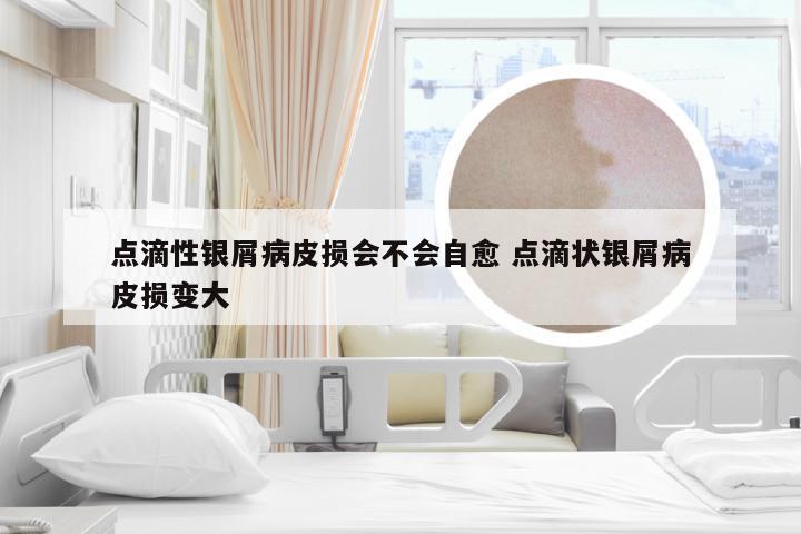 点滴性银屑病皮损会不会自愈 点滴状银屑病皮损变大