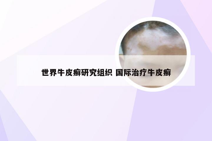 世界牛皮癣研究组织 国际治疗牛皮癣