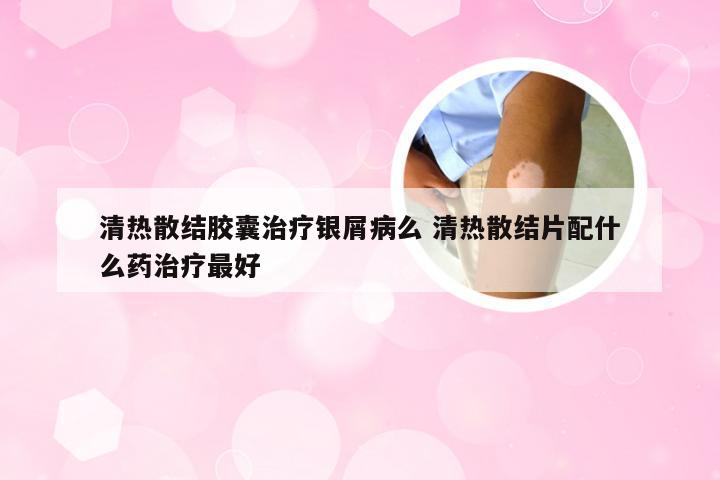 清热散结胶囊治疗银屑病么 清热散结片配什么药治疗最好