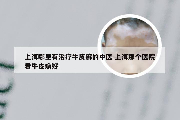 上海哪里有治疗牛皮癣的中医 上海那个医院看牛皮癣好