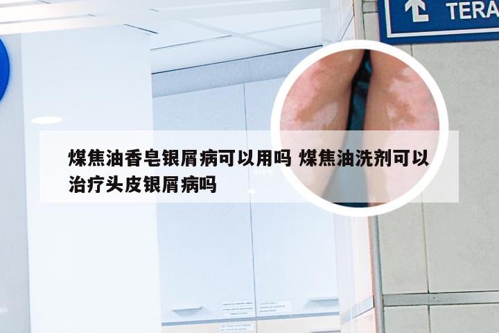 煤焦油香皂银屑病可以用吗 煤焦油洗剂可以治疗头皮银屑病吗