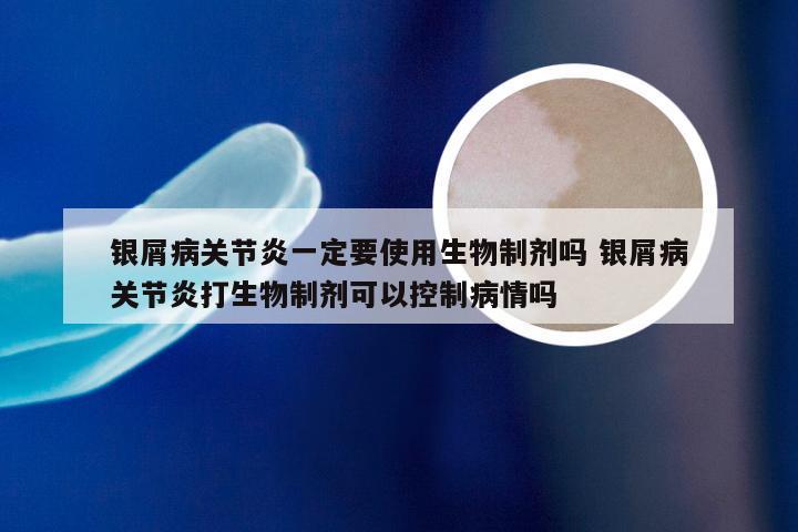银屑病关节炎一定要使用生物制剂吗 银屑病关节炎打生物制剂可以控制病情吗