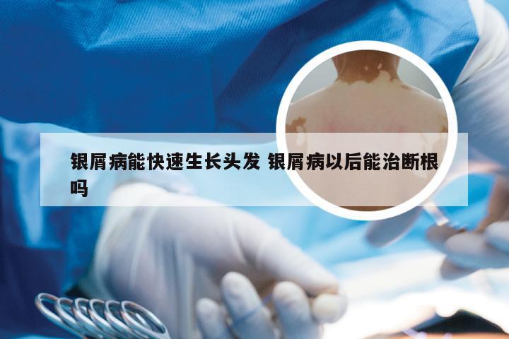 银屑病能快速生长头发 银屑病以后能治断根吗