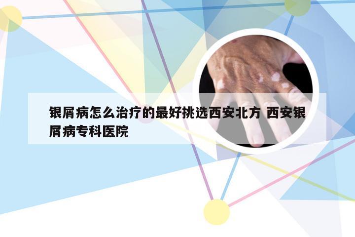 银屑病怎么治疗的最好挑选西安北方 西安银屑病专科医院
