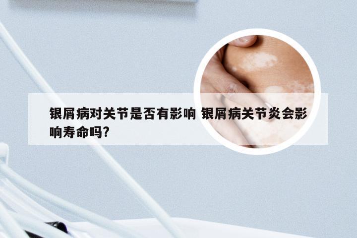 银屑病对关节是否有影响 银屑病关节炎会影响寿命吗?