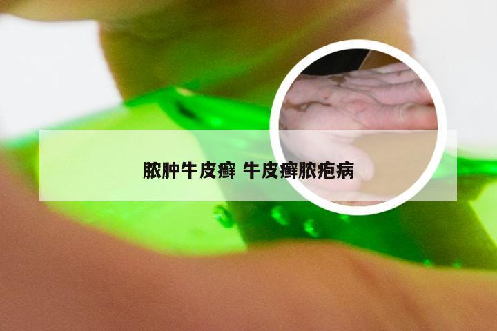 脓肿牛皮癣 牛皮癣脓疱病