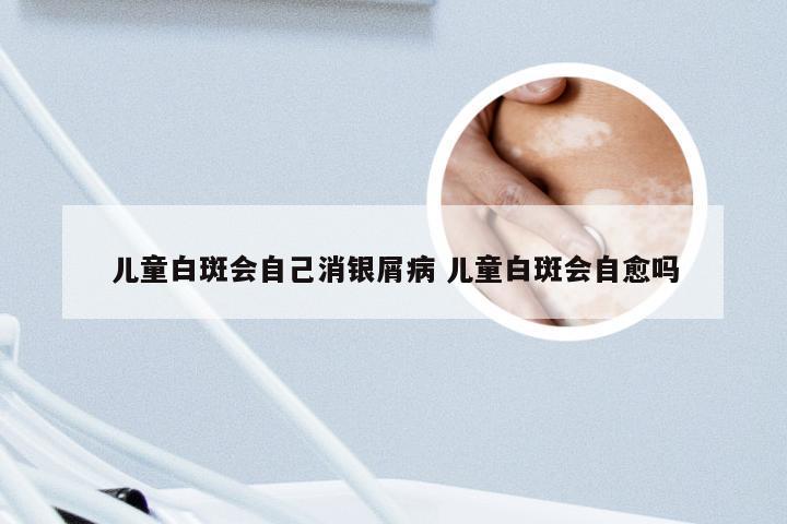 儿童白斑会自己消银屑病 儿童白斑会自愈吗