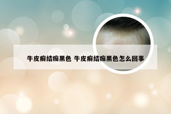牛皮癣结痂黑色 牛皮癣结痂黑色怎么回事