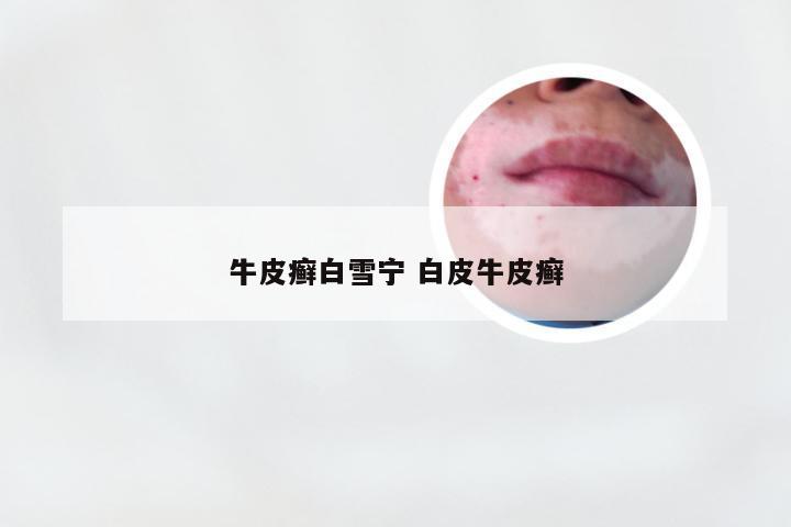 牛皮癣白雪宁 白皮牛皮癣