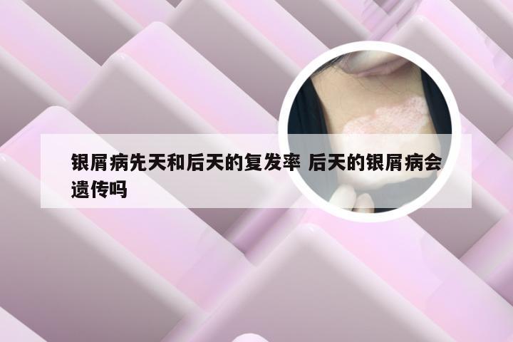 银屑病先天和后天的复发率 后天的银屑病会遗传吗