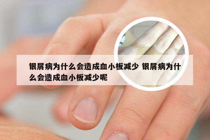 银屑病为什么会造成血小板减少 银屑病为什么会造成血小板减少呢