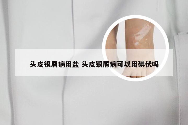 头皮银屑病用盐 头皮银屑病可以用碘伏吗