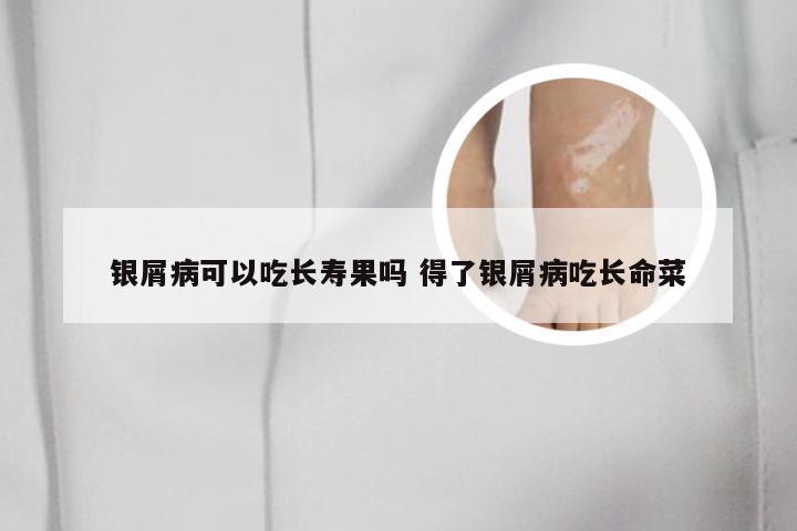 银屑病可以吃长寿果吗 得了银屑病吃长命菜