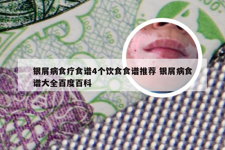 银屑病食疗食谱4个饮食食谱推荐 银屑病食谱大全百度百科