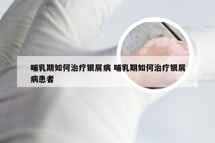 哺乳期如何治疗银屑病 哺乳期如何治疗银屑病患者