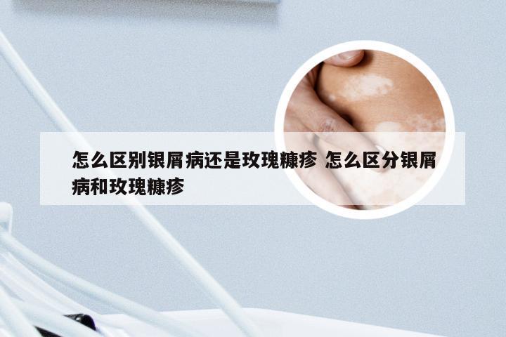 怎么区别银屑病还是玫瑰糠疹 怎么区分银屑病和玫瑰糠疹