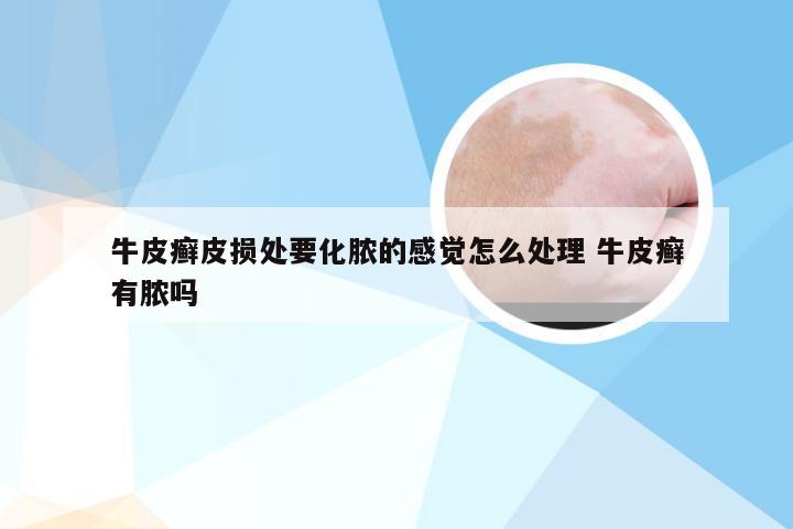 牛皮癣皮损处要化脓的感觉怎么处理 牛皮癣有脓吗