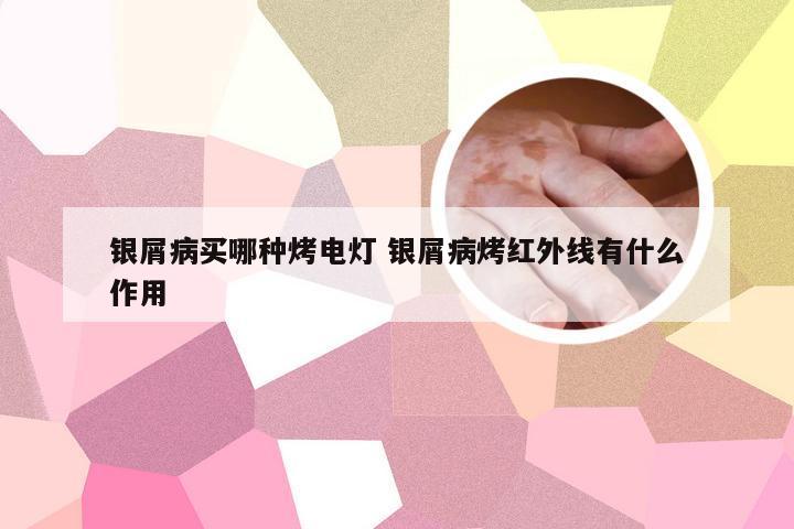 银屑病买哪种烤电灯 银屑病烤红外线有什么作用