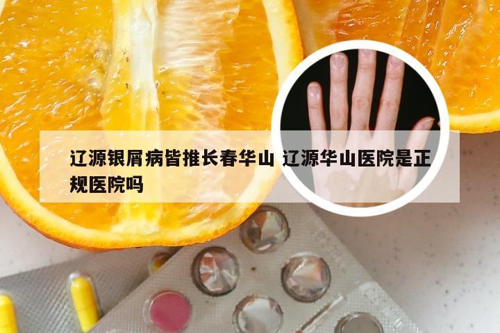 辽源银屑病皆推长春华山 辽源华山医院是正规医院吗