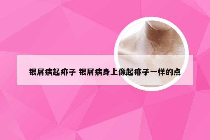 银屑病起痱子 银屑病身上像起痱子一样的点