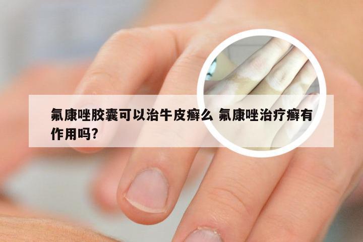 氟康唑胶囊可以治牛皮癣么 氟康唑治疗癣有作用吗?