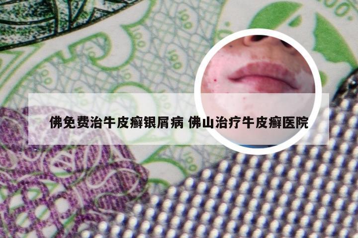 佛免费治牛皮癣银屑病 佛山治疗牛皮癣医院