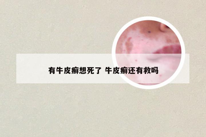 有牛皮癣想死了 牛皮癣还有救吗