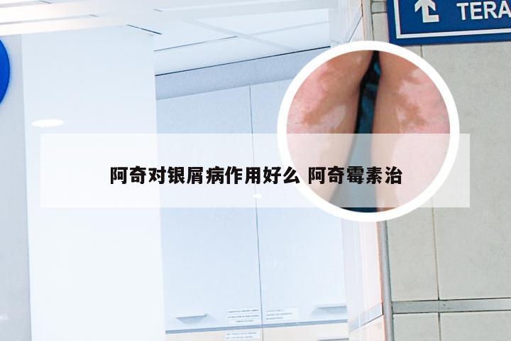 阿奇对银屑病作用好么 阿奇霉素治