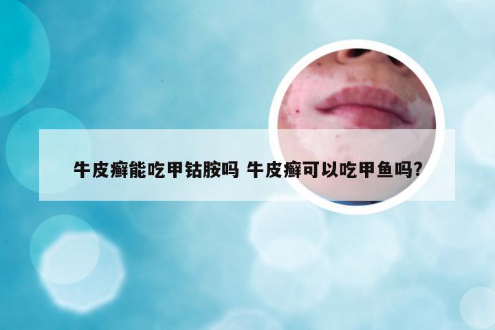 牛皮癣能吃甲钴胺吗 牛皮癣可以吃甲鱼吗?