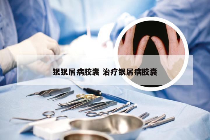 银银屑病胶囊 治疗银屑病胶囊
