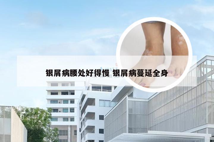 银屑病腰处好得慢 银屑病蔓延全身