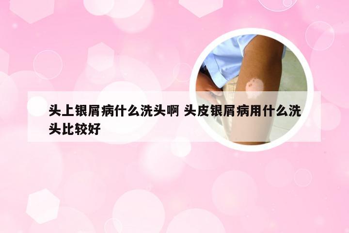 头上银屑病什么洗头啊 头皮银屑病用什么洗头比较好