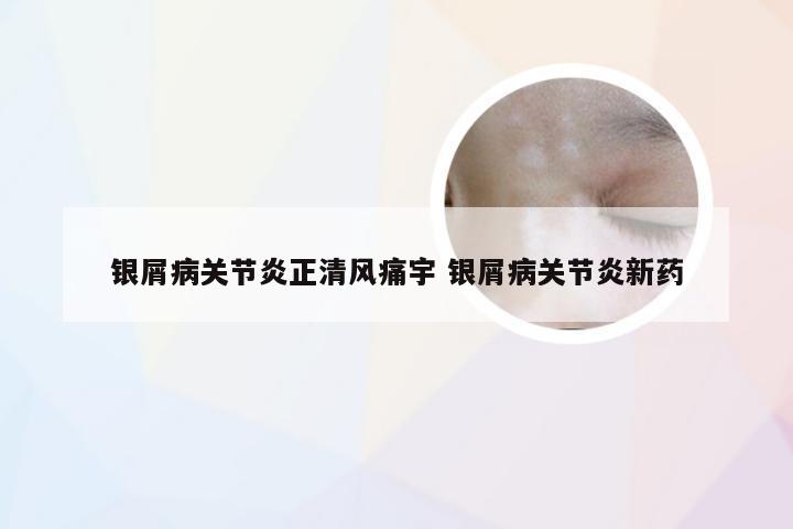 银屑病关节炎正清风痛宇 银屑病关节炎新药