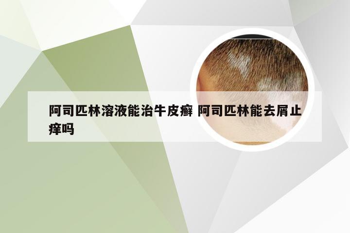 阿司匹林溶液能治牛皮癣 阿司匹林能去屑止痒吗