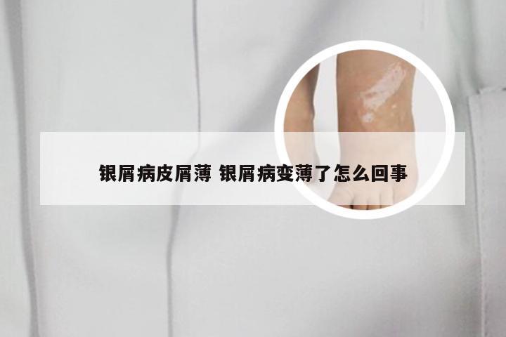 银屑病皮屑薄 银屑病变薄了怎么回事