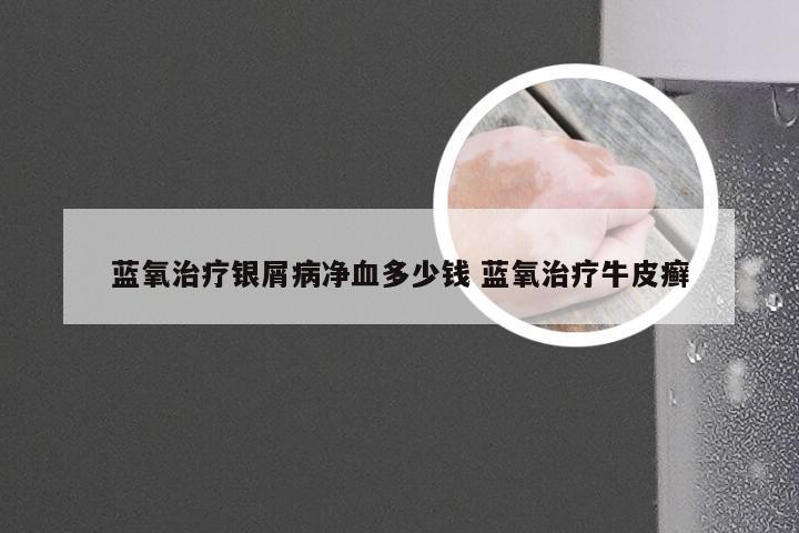 蓝氧治疗银屑病净血多少钱 蓝氧治疗牛皮癣