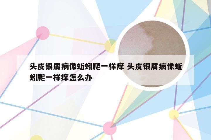 头皮银屑病像蚯蚓爬一样痒 头皮银屑病像蚯蚓爬一样痒怎么办