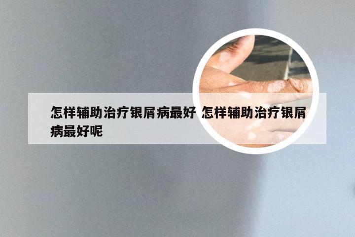 怎样辅助治疗银屑病最好 怎样辅助治疗银屑病最好呢