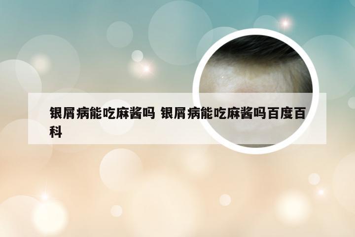 银屑病能吃麻酱吗 银屑病能吃麻酱吗百度百科