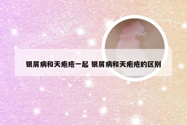 银屑病和天疱疮一起 银屑病和天疱疮的区别