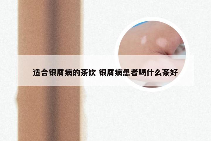 适合银屑病的茶饮 银屑病患者喝什么茶好
