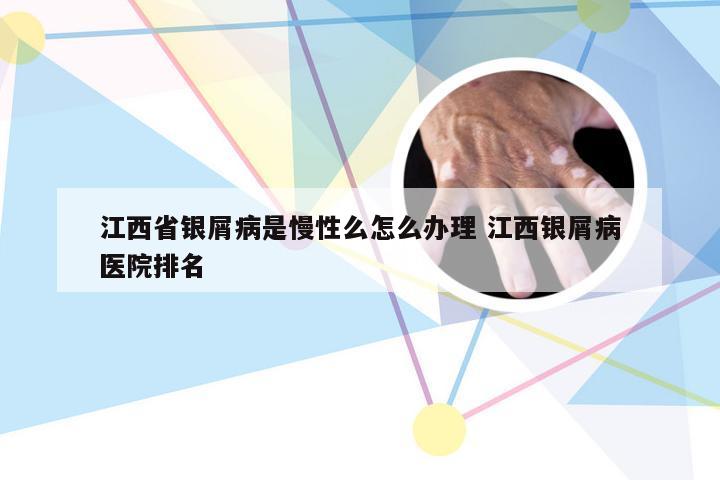 江西省银屑病是慢性么怎么办理 江西银屑病医院排名