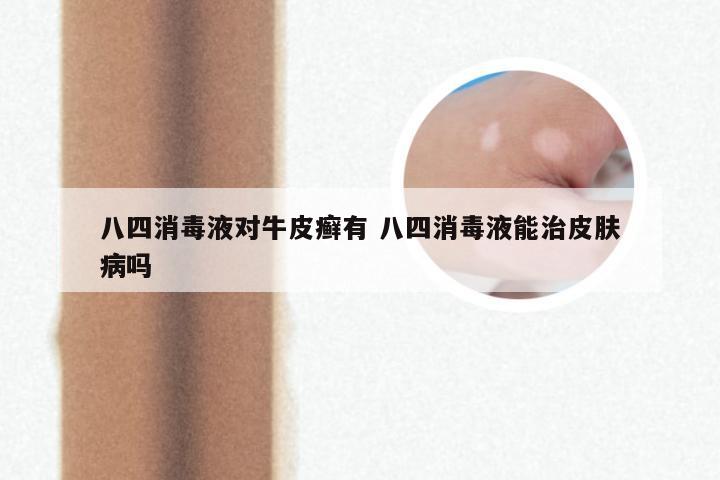 八四消毒液对牛皮癣有 八四消毒液能治皮肤病吗
