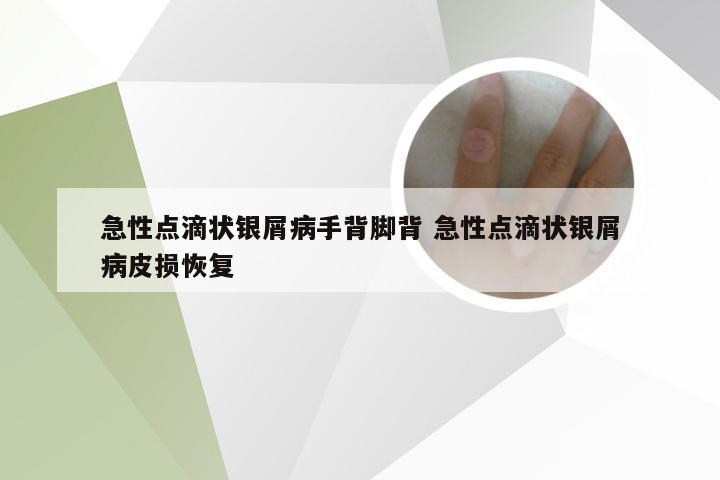 急性点滴状银屑病手背脚背 急性点滴状银屑病皮损恢复
